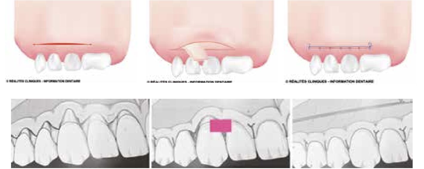 greffes-gencives-boulogne-billancourt-paroexpert