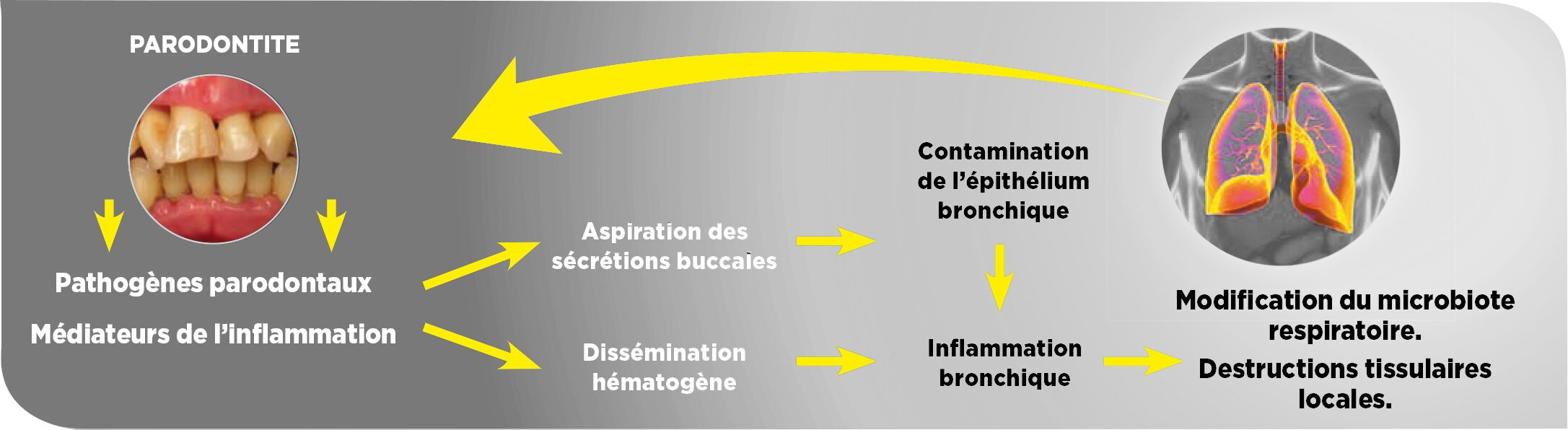 BCPO-maladies-parodontales-paro-expert