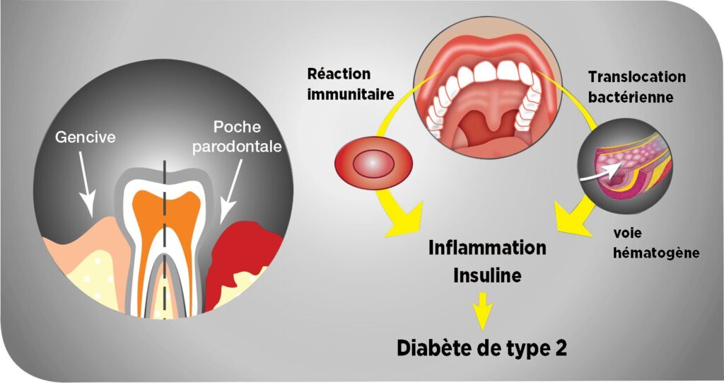 diabète-maladie-parodontale-paro-expert
