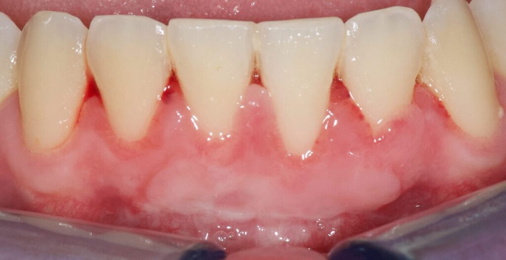 Gingivite-parodontite-maladie-gencive