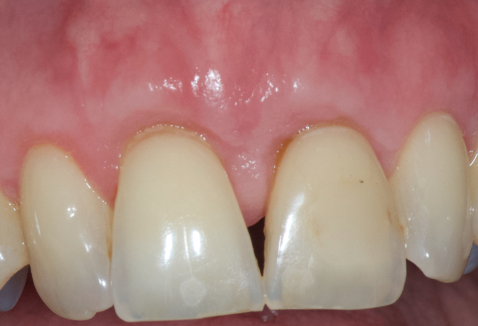 parodontal-gencivite-parodontie-traitement-résultat