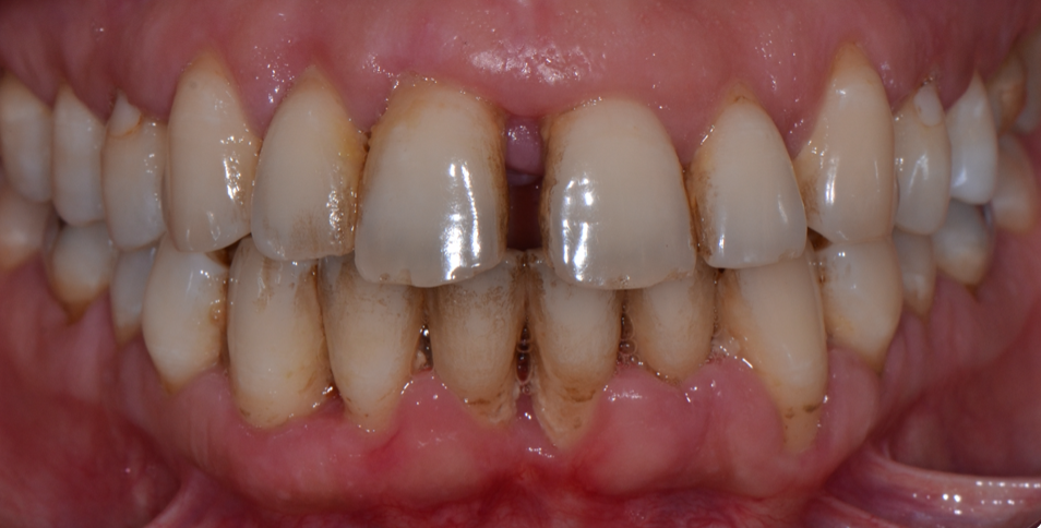 Parodontite-dent-gencive-traitement