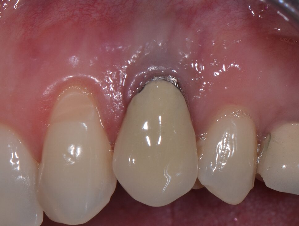lefloch-dent-gencive-maladie