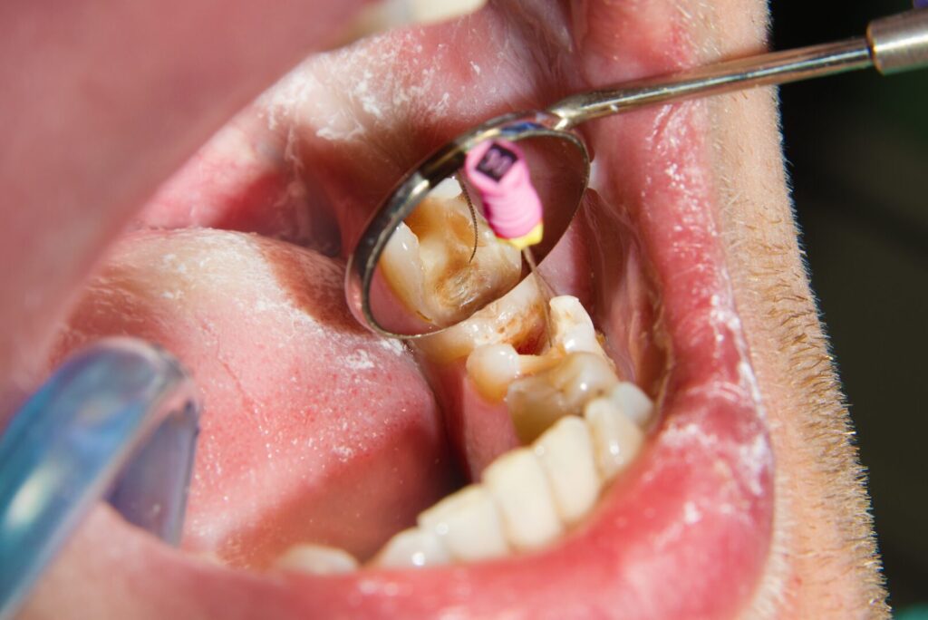 traitement endodontique Boulogne Billancourt