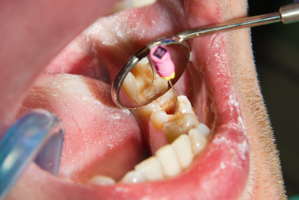 traitement endodontique Boulogne Billancourt